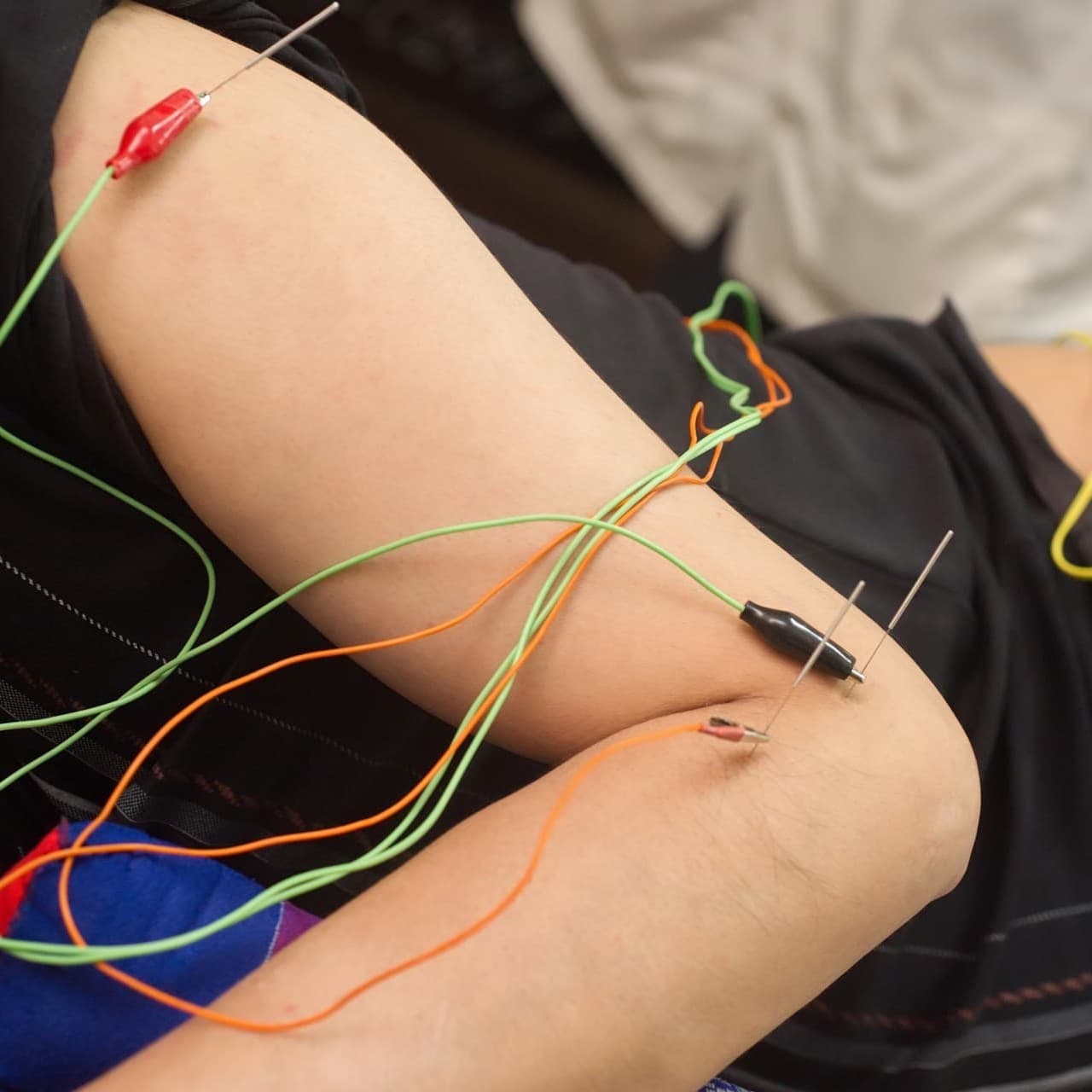 Neuromodulación percutánea en Verín