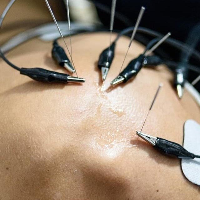 Neuromodulación contra el dolor crónico